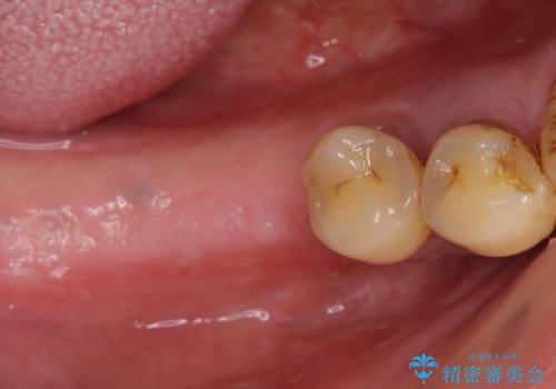 歯がないまま放置していた　奥歯のインプラント　50代男性の症例 治療前