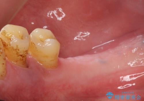 歯がぐらぐら 再生療法で抜かずに残す 50代男性の治療前