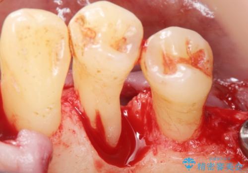 歯がぐらぐら 再生療法で抜かずに残す 50代男性の治療中