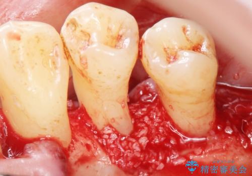 歯がぐらぐら 再生療法で抜かずに残す 50代男性の治療中