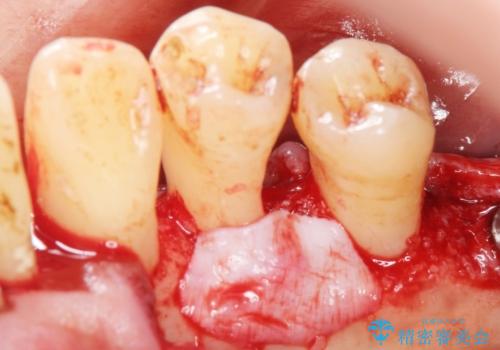 歯がぐらぐら 再生療法で抜かずに残す 50代男性の治療中