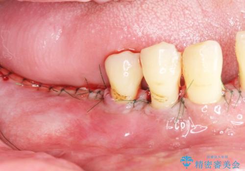 歯がぐらぐら 再生療法で抜かずに残す 50代男性の治療中