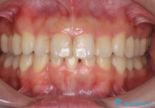 出っ歯　下の歯のガタガタ　下の前歯のみ1本抜歯　マウスピースで1年の治療後