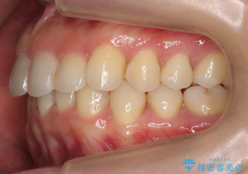 出っ歯　下の歯のガタガタ　下の前歯のみ1本抜歯　マウスピースで1年の治療後