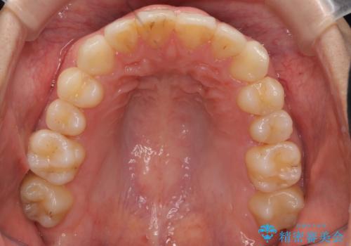 出っ歯 下の歯のガタガタ 下の前歯のみ1本抜歯 マウスピースで1年の治療後