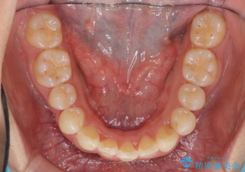 出っ歯 下の歯のガタガタ 下の前歯のみ1本抜歯 マウスピースで1年の治療後