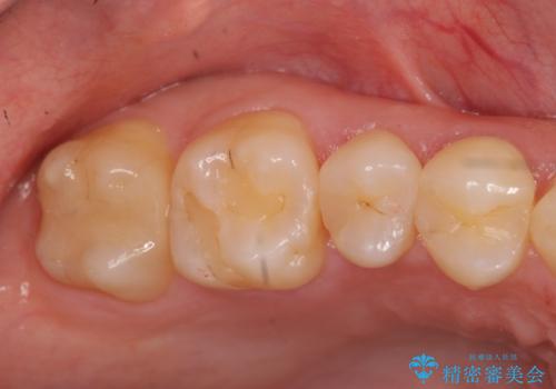 奥歯の虫歯　歯の間を広げてセラミックでしっかり治療の治療後