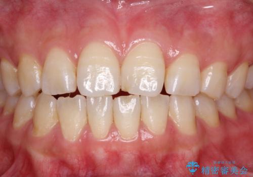 光学3Dスキャナー【iTero Element】でスキャニング前にPMTCの治療前