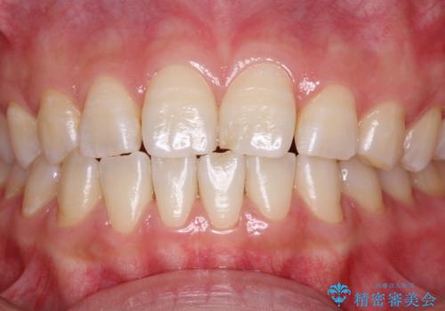 光学3Dスキャナー【iTero Element】でスキャニング前にPMTCの治療後