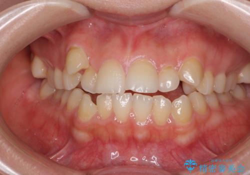 目立ちにくい抜歯矯正 ハーフリンガルの症例 治療前