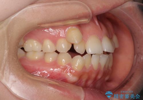 目立ちにくい抜歯矯正 ハーフリンガルの治療前