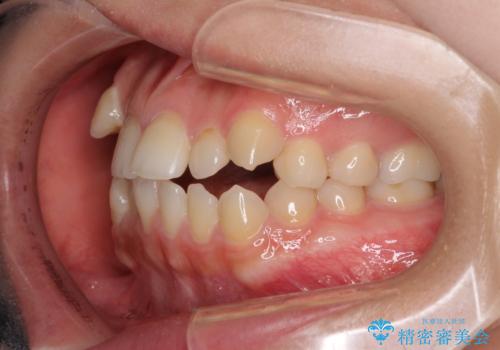 目立ちにくい抜歯矯正 ハーフリンガルの治療前