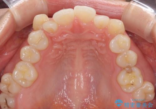 目立ちにくい抜歯矯正 ハーフリンガルの治療前