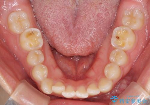 目立ちにくい抜歯矯正 ハーフリンガルの治療前