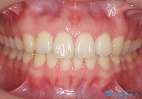 下の前歯が1本短い インビザラインと部分矯正の組み合わせの症例 治療後