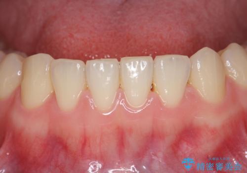 下の前歯が1本短い インビザラインと部分矯正の組み合わせの治療後