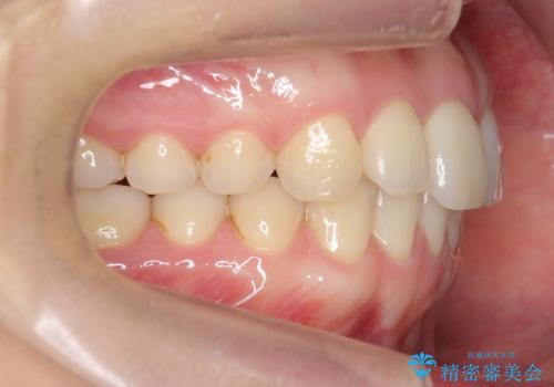 下の前歯が1本短い インビザラインと部分矯正の組み合わせの治療後