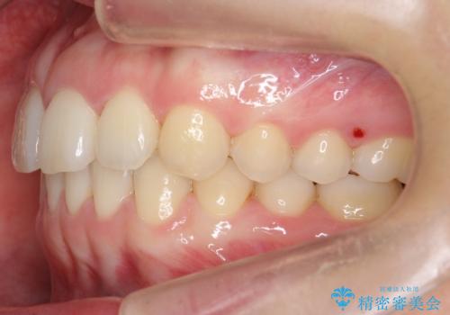 下の前歯が1本短い インビザラインと部分矯正の組み合わせの治療後