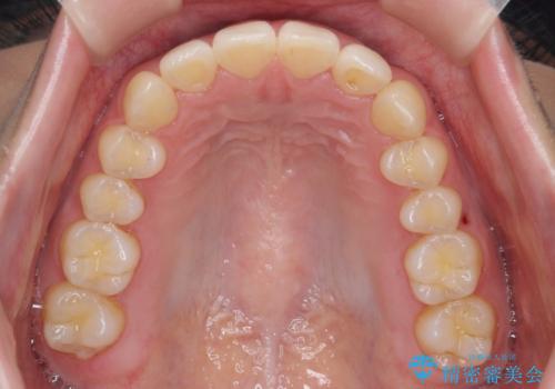 下の前歯が1本短い インビザラインと部分矯正の組み合わせの治療後