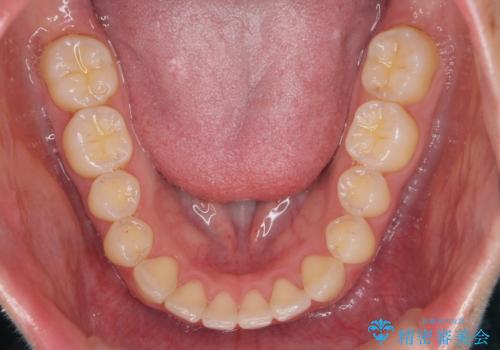 下の前歯が1本短い　インビザラインと部分矯正の組み合わせの治療後