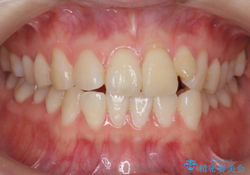 前歯が気になる　大人のマウスピース矯正　矮小歯を整えるの症例 治療前