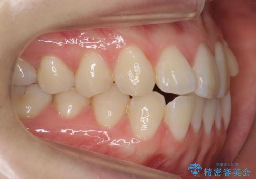 前歯が気になる 大人のマウスピース矯正 矮小歯を整えるの治療前