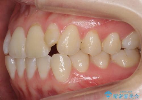前歯が気になる　大人のマウスピース矯正　矮小歯を整えるの治療前