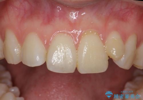 小さい前歯を整える　セラミック矯正の治療前