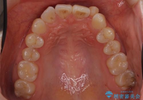 前歯が気になる 大人のマウスピース矯正 矮小歯を整えるの治療前