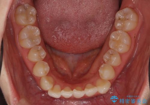 前歯が気になる　大人のマウスピース矯正　矮小歯を整えるの治療前