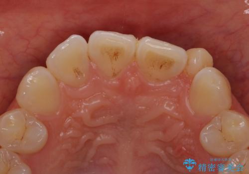 小さい前歯を整える セラミック矯正の治療前