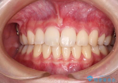 治療途中で転院 抜歯矯正の仕上げ治療の症例 治療後