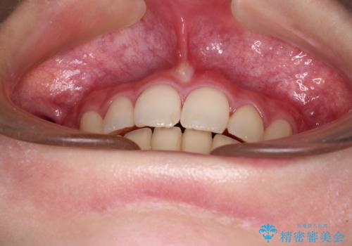 治療途中で転院 抜歯矯正の仕上げ治療の治療後