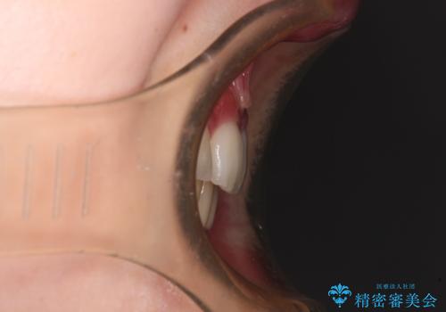 治療途中で転院 抜歯矯正の仕上げ治療の治療後