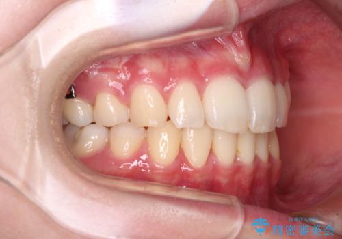治療途中で転院 抜歯矯正の仕上げ治療の治療後