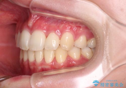 治療途中で転院 抜歯矯正の仕上げ治療の治療後