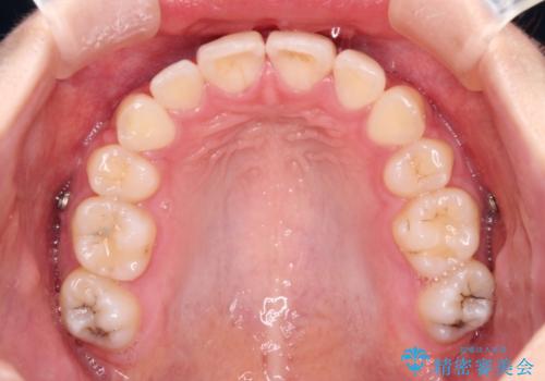 治療途中で転院 抜歯矯正の仕上げ治療の治療後