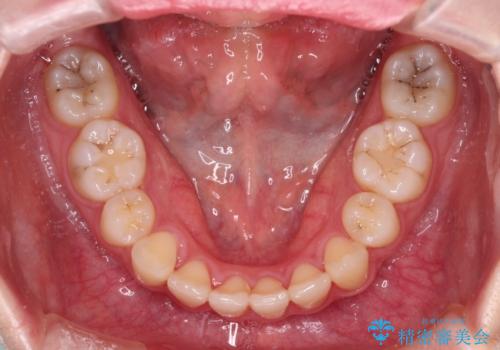 治療途中で転院 抜歯矯正の仕上げ治療の治療後