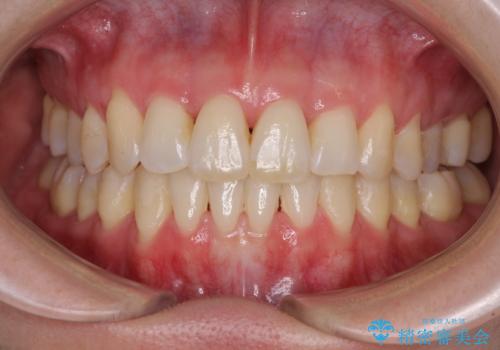 急速拡大装置で奥歯の咬み合わせを改善　インビザラインによる矯正治療の症例 治療後
