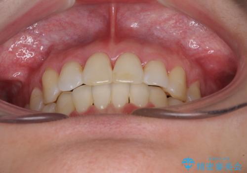 急速拡大装置で奥歯の咬み合わせを改善 インビザラインによる矯正治療の治療後