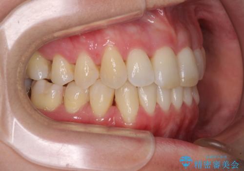 急速拡大装置で奥歯の咬み合わせを改善 インビザラインによる矯正治療の治療後