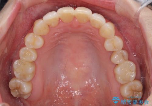 急速拡大装置で奥歯の咬み合わせを改善　インビザラインによる矯正治療の治療後