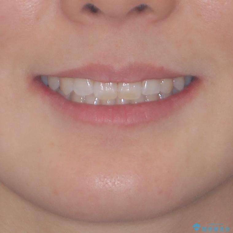 急速拡大装置で奥歯の咬み合わせを改善 インビザラインによる矯正治療の治療後(顔貌)