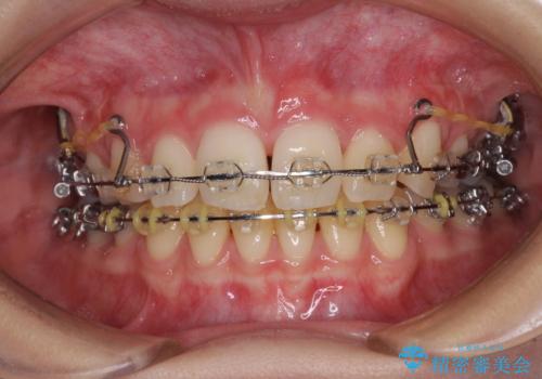 治療途中で転院　抜歯矯正の仕上げ治療の症例 治療前