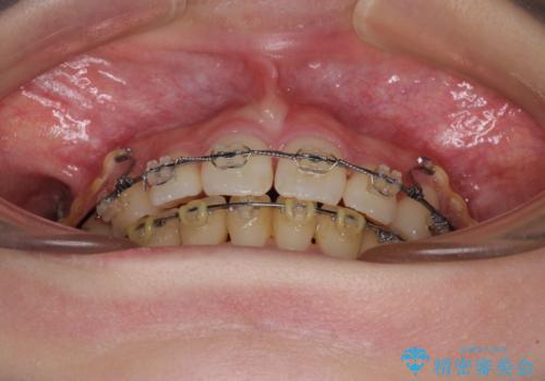 治療途中で転院 抜歯矯正の仕上げ治療の治療前