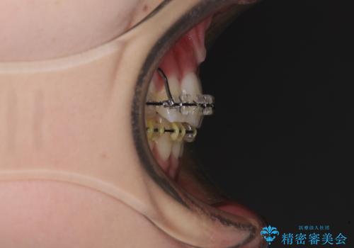 治療途中で転院 抜歯矯正の仕上げ治療の治療前