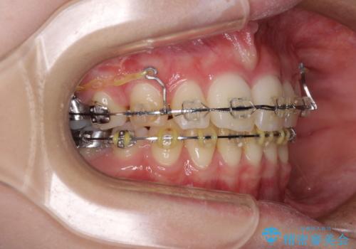 治療途中で転院 抜歯矯正の仕上げ治療の治療前