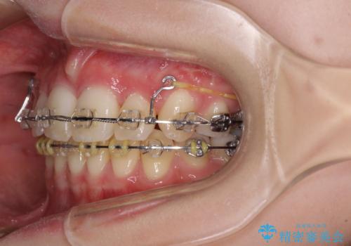 治療途中で転院 抜歯矯正の仕上げ治療の治療前