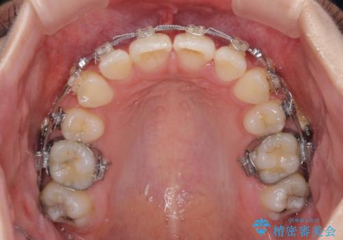治療途中で転院 抜歯矯正の仕上げ治療の治療前