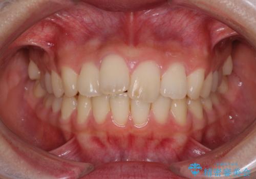 就職前にきれいな歯並びにしたい 大学生のインビザライン矯正の症例 治療前